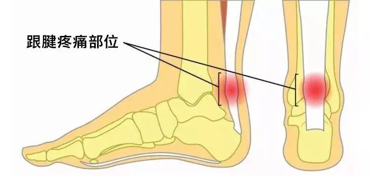 冉冉科普 | 得了跟腱炎怎么办？ 跟腱炎康复动作在这里！        1.跟腱炎的描述2.跟腱炎的类型3.跟腱炎产生的原因4.跟腱炎的常见症状5.跟腱炎的康复动作