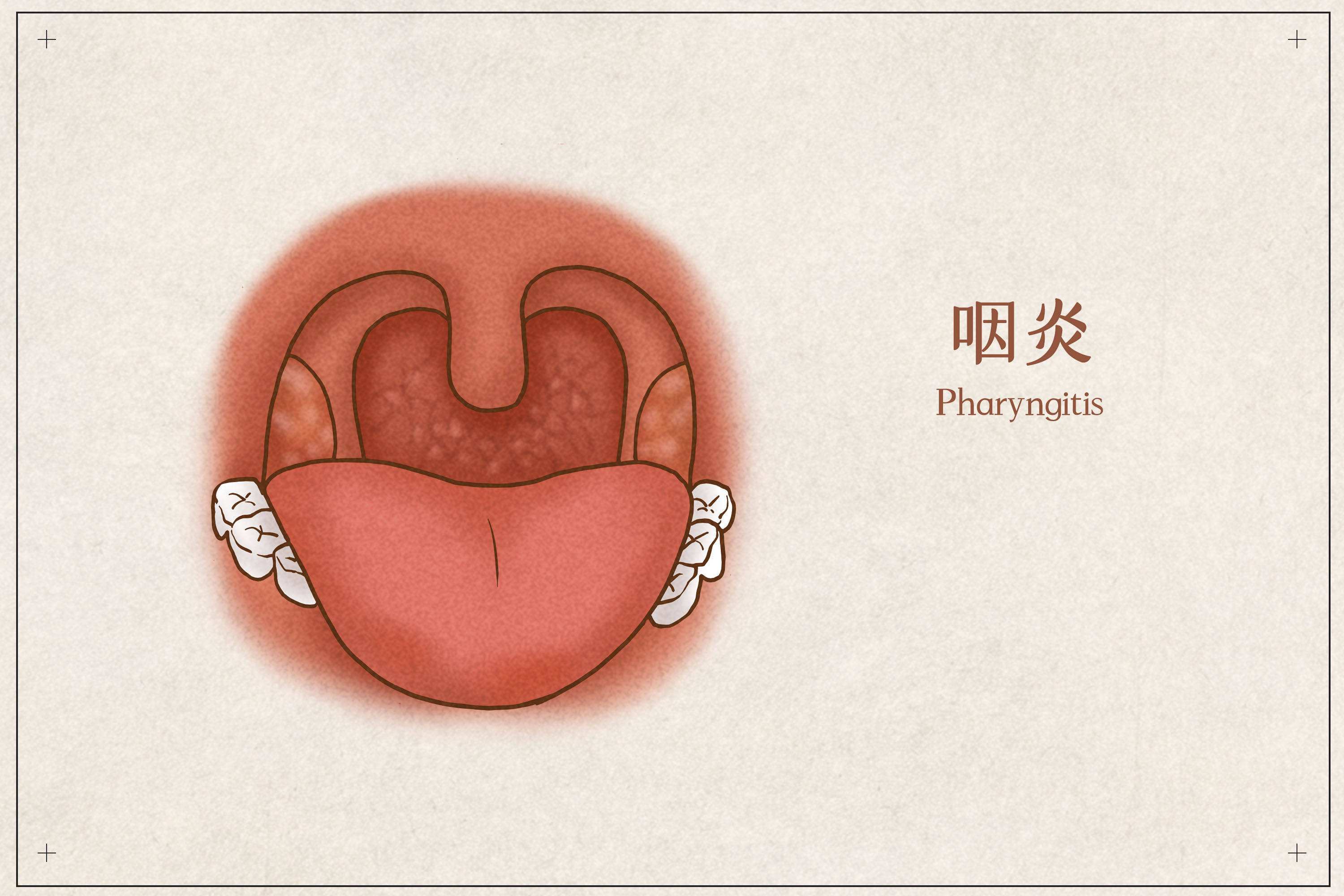 咽炎是怎么引起的?重庆内科医院哪家好? - 哔哩哔哩