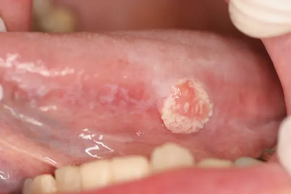 这可能是一颗隐形炸弹，会引起口腔癌- 哔哩哔哩