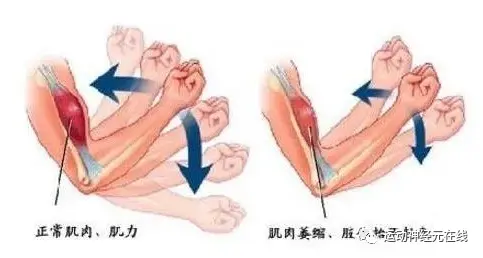 运动神经元 肌萎缩侧索硬化 哔哩哔哩