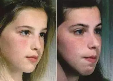 儿童鼾症怎么处理?