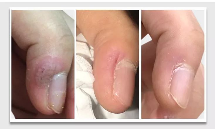 你不得不看的「甲疣」2.0 经典案例