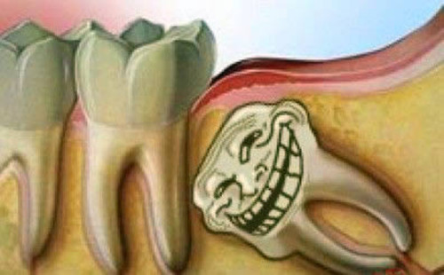 智齿拔除示意图