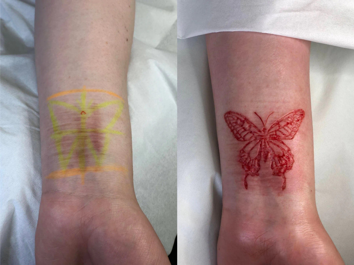 割皮纹身师小爱告诉我，女孩们用剥离皮肤的方式掩盖过去的伤痕_人体