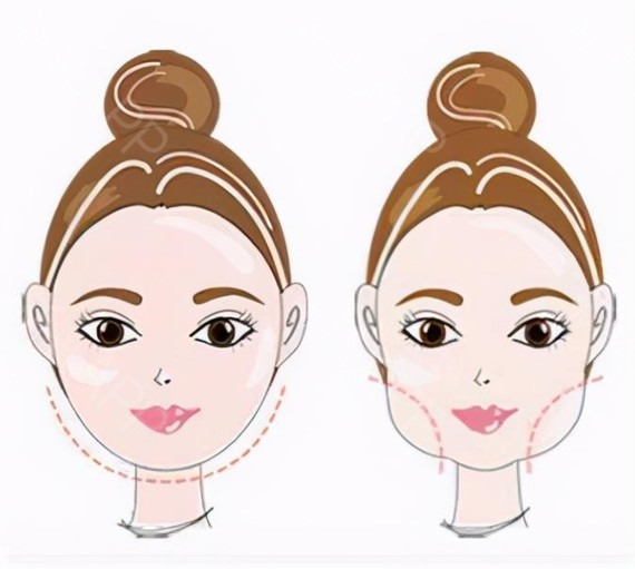 面部脂肪填充多久消肿脂肪胶填充几天消肿?一个美丽女人的自我修养