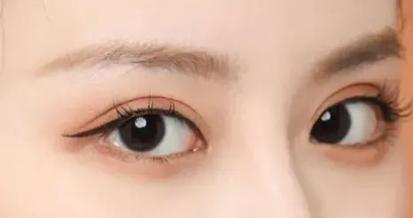 间距过短的人不适合做双眼皮手术(可根据「三庭五眼」标准粗略判断,但