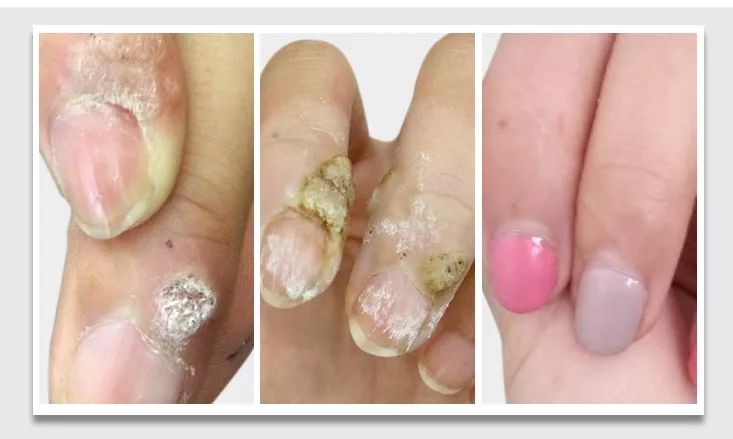 你不得不看的「甲疣」2.0 经典案例