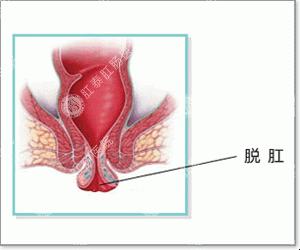 女性肛门下坠图片