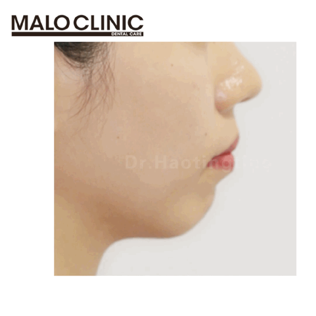 上海牙齿矫正郝婷婷正畸案例 案例集合gif 扶正凸系面型 圆梦 立体侧颜 哔哩哔哩