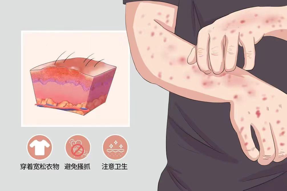 皮肤剧烈瘙痒,竟是湿疹!史上最全13种治湿疹中成药,医生总结 - 哔哩哔哩