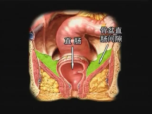 直肠肛管周围间隙