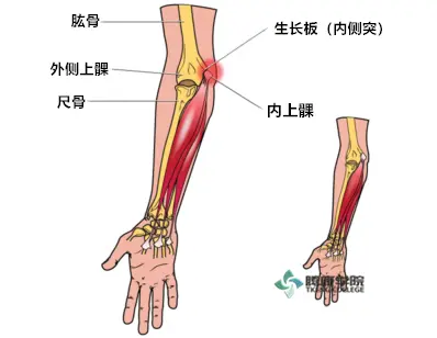 棒球肘诊疗分析与运动康复 肱骨内上髁撕脱骨折 哔哩哔哩