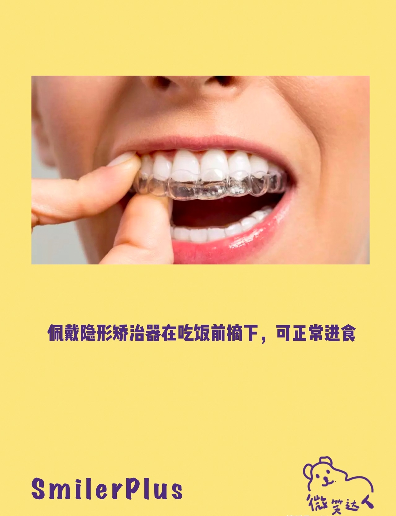 长沙牙齿矫正周权正畸案例解析：利用隐适美在推磨牙向后的方案上的优势建立健康咬颌 - 哔哩哔哩
