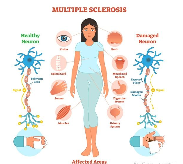 面对多发性硬化：探索诊断与治疗的新路径