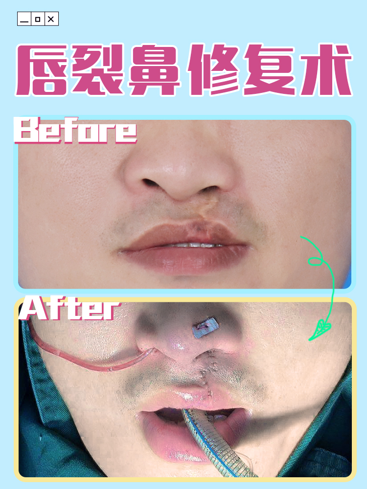 唇裂修复案例: 唇裂1期术后唇峰不连续情况