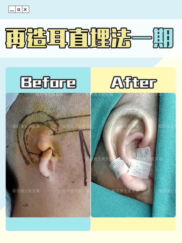 耳再造直埋一期术后图