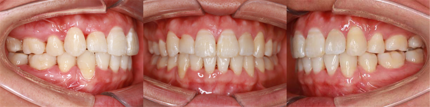 西安牙齿矫正张军主任正畸案例集:牙齿拥挤,前突的隐适美隐形矫正案例