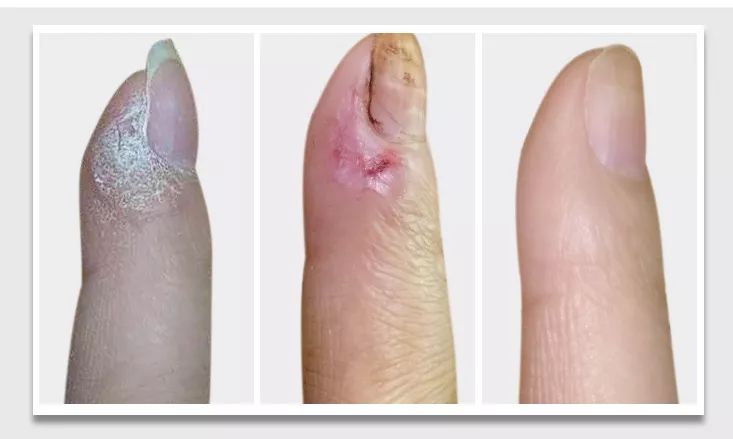 你不得不看的甲疣10经典案例