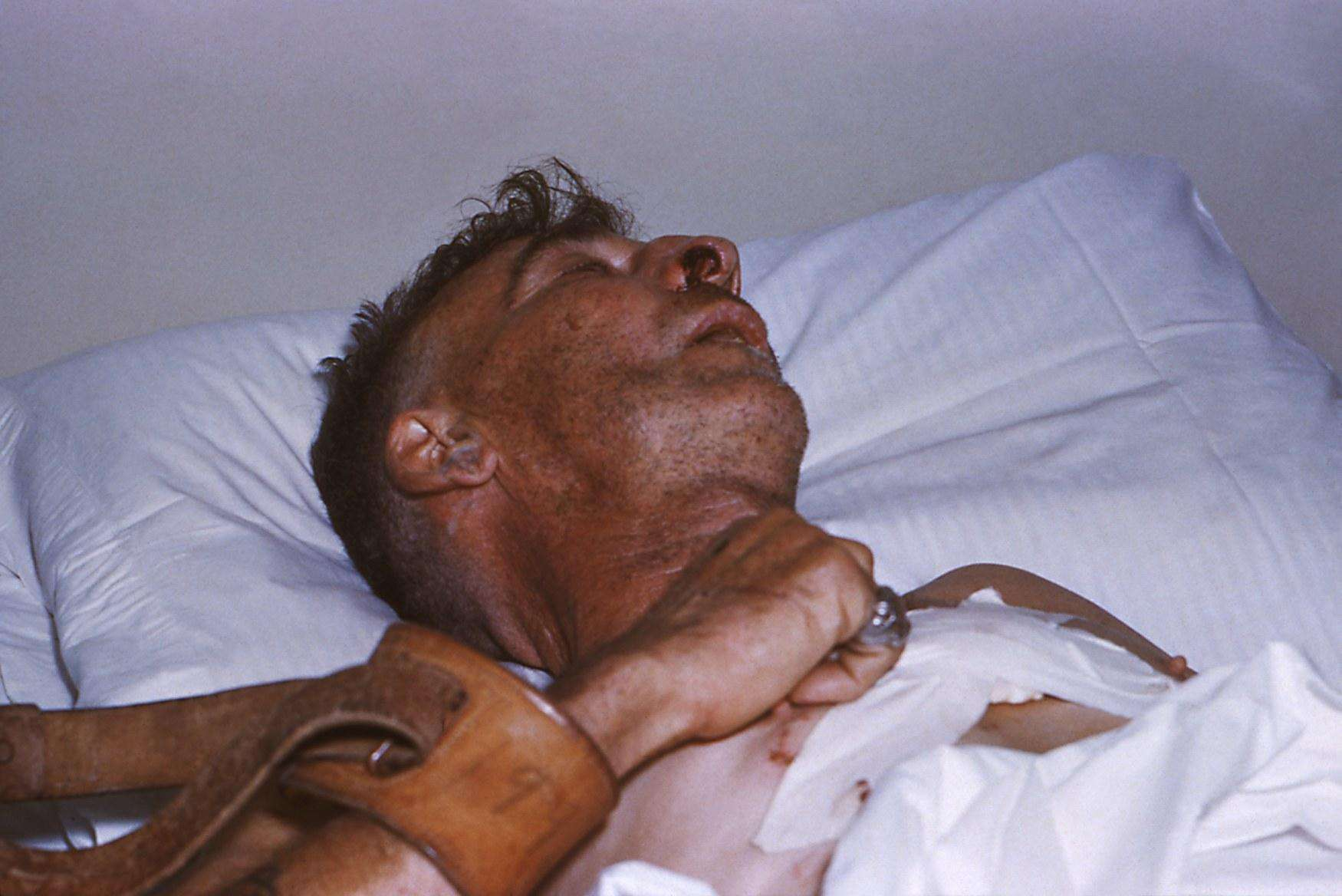 痉挛性截瘫你不知道的秘密