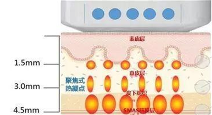 做超声刀后吃辣会怎样,超声刀后吃辣椒危害,别不当回事