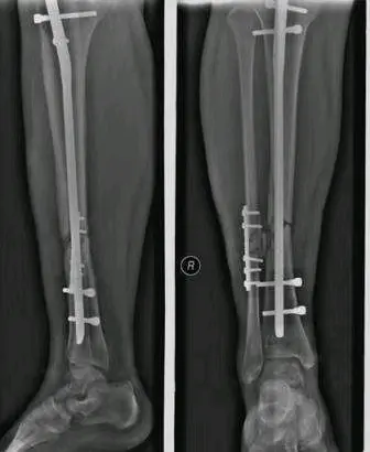 胫腓骨骨折 几个月不长骨痂 康复该如何介入 哔哩哔哩