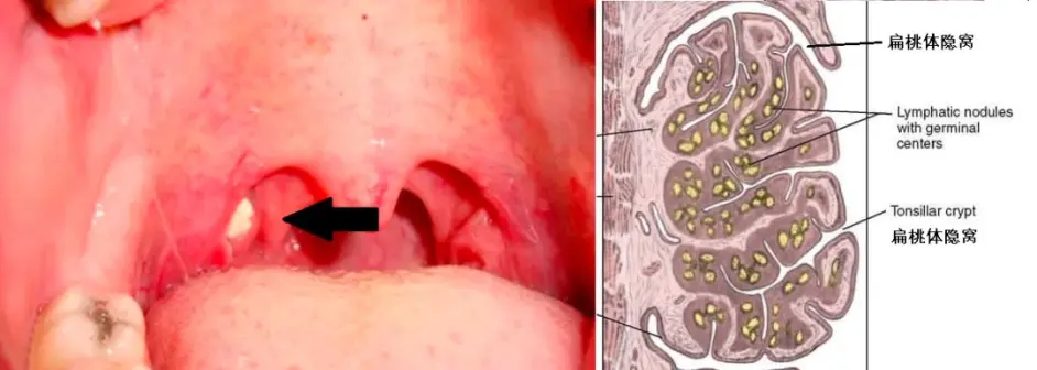 10 以上的人 扁桃体上都会长结石 哔哩哔哩
