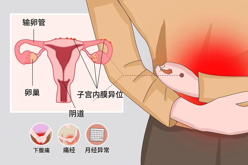 不孕的主因之一 子宫内膜异位症 育龄女性日常要多注意 哔哩哔哩