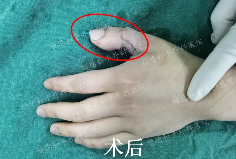 什么是3d全形手指再造?