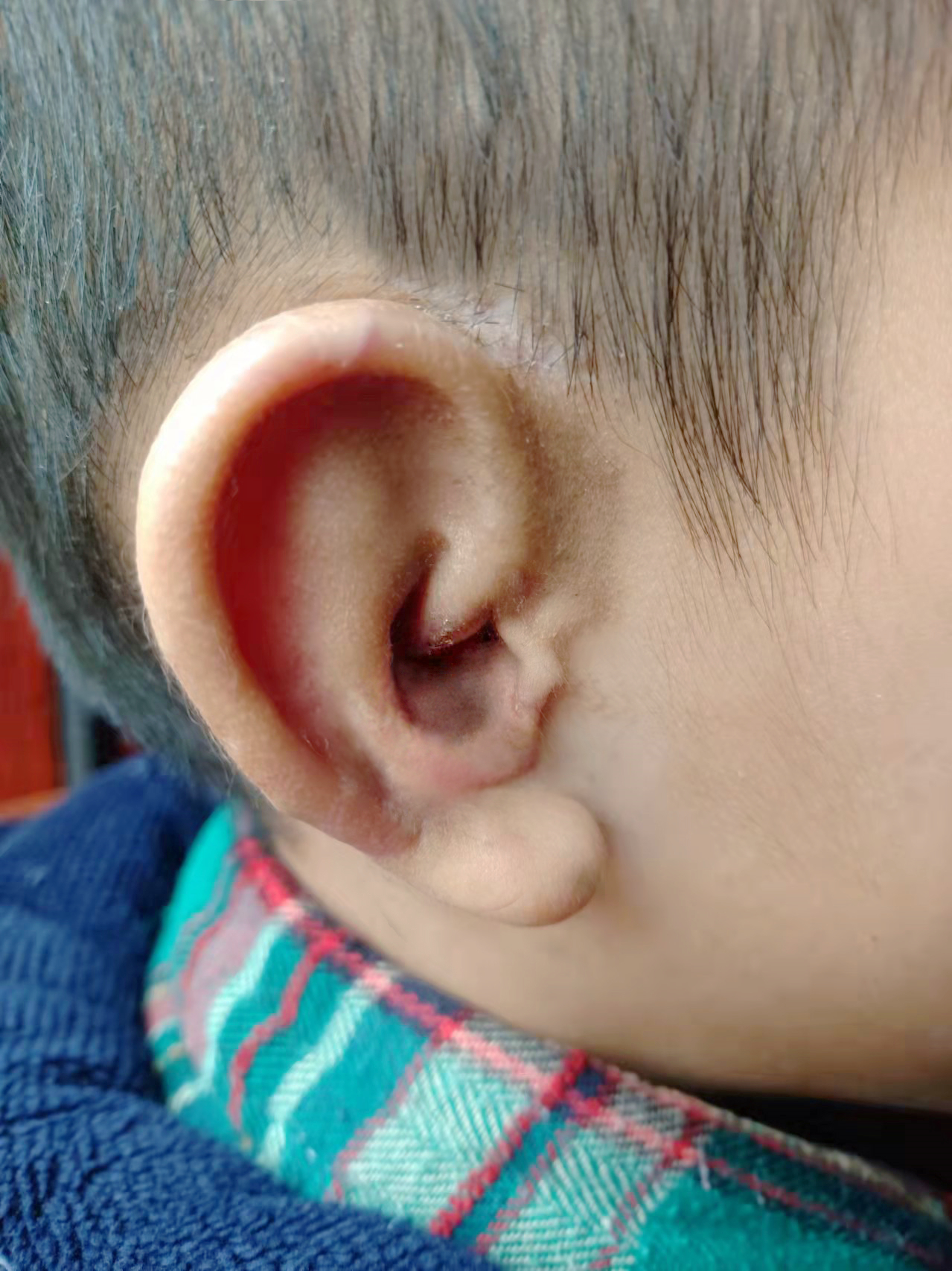 精灵耳、招风耳……新生儿耳廓畸形，矫正要趁早
