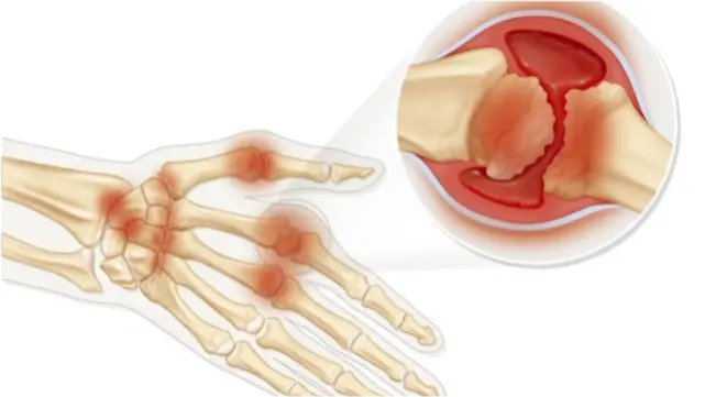 双手贴满膏药的 七一勋章 获得者张桂梅老师到底患了什么病 哔哩哔哩