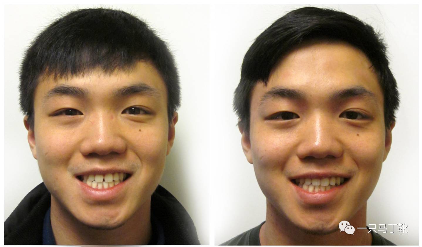 郑州牙齿矫正|记录我整牙2年内收5mm的变化 - 知乎