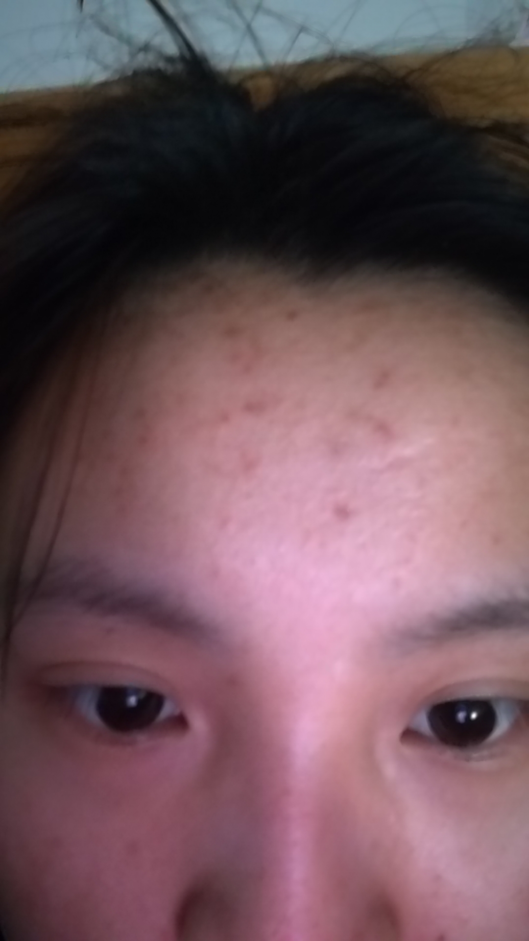 额头的痘印这都是陈年老印了