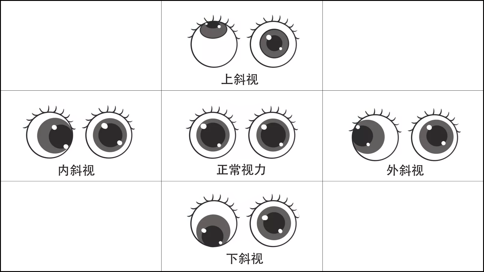 北京明亮眼科-弱视与斜视分类