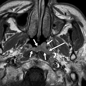 MRI And CT Of Nasopharyngeal Carcinoma - 哔哩哔哩