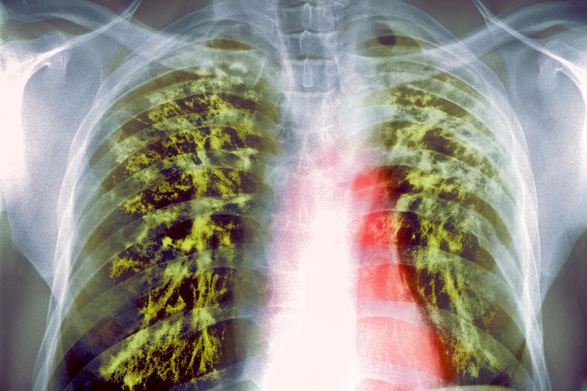 什么是肺结核，传播途径有哪些？怎么可以有效预防肺结核？