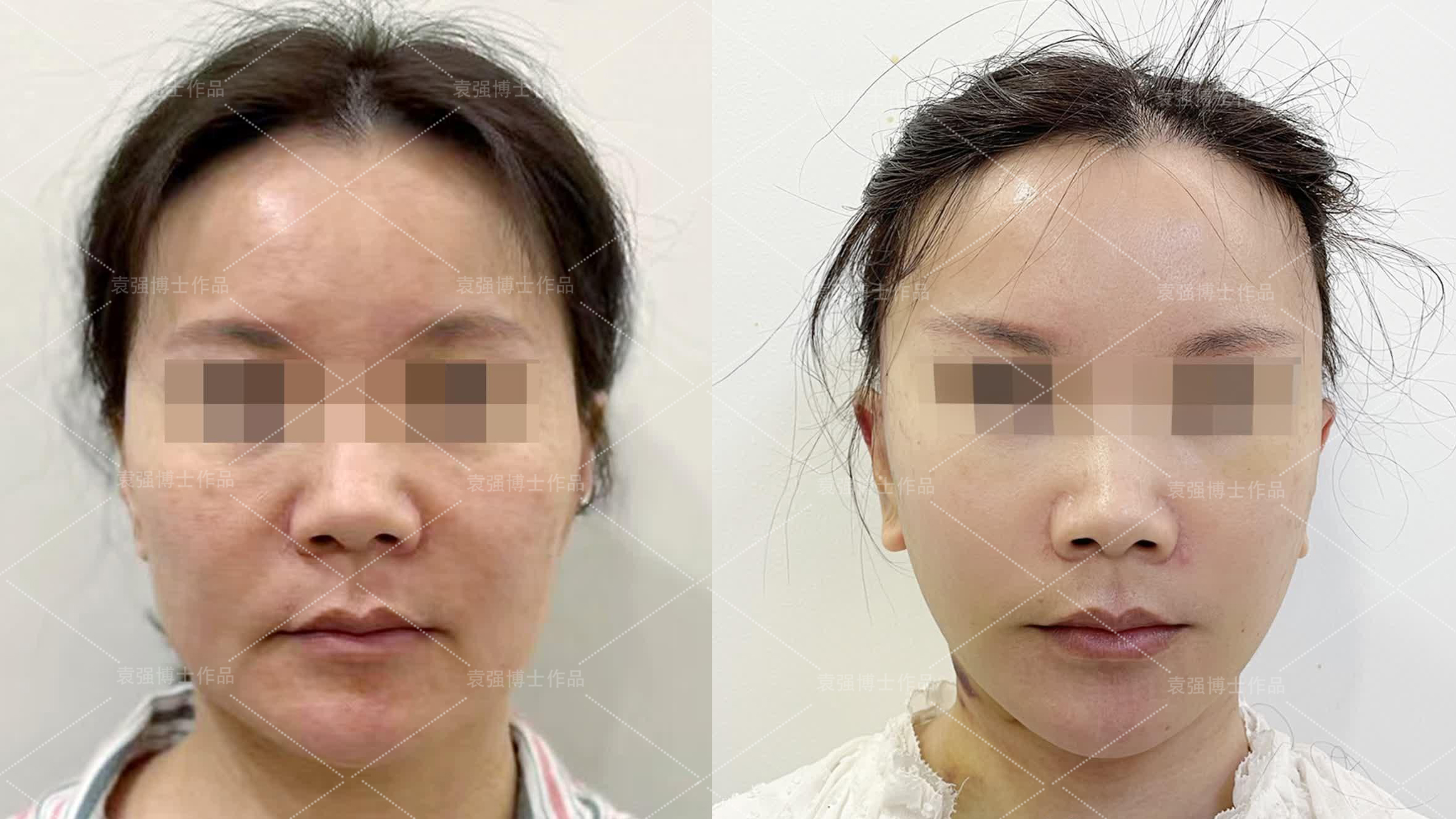 上海华美医疗美容医院V-LINE瓜子脸手术怎么样_恢复过程_效果如何_动感光波哔哔整形日记6.13_新氧美容整形