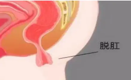 けがをするビジネス管理する脱肛初期 Kelvin Web Jp