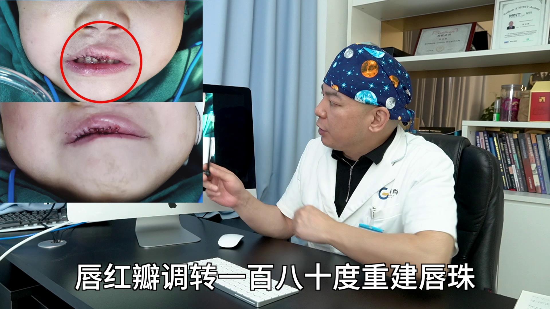 【医学3D】兔唇 唇裂修复-医视屏-3D-医视屏-3D-哔哩哔哩视频