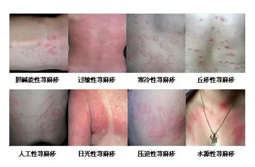 荨麻疹 吃 出来的过敏性皮肤病 从根本上调理需注意这四点 哔哩哔哩