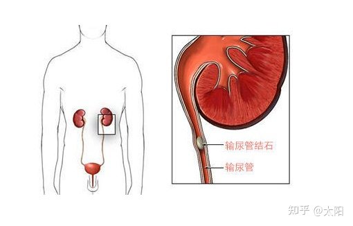 消失的输尿管结石.蓦然回首,却在.