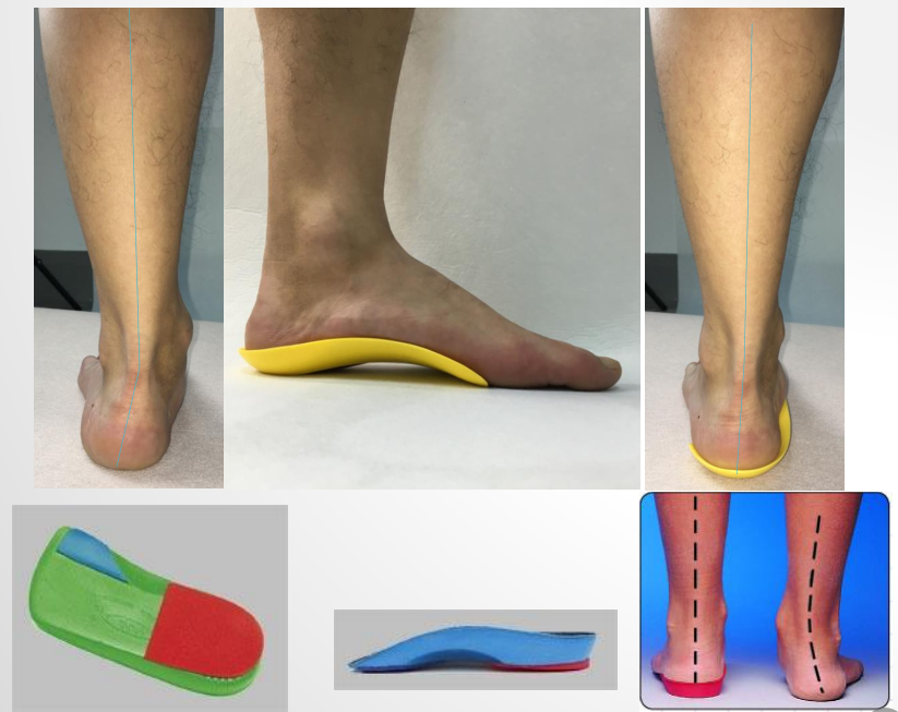 标志:距下关节中立位 (2)消除高压痛点, 标志:无应力集中区域出现