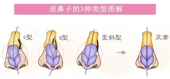 厦门隆鼻修复 鼻子歪斜是什么原因导致的 如何矫正 哔哩哔哩