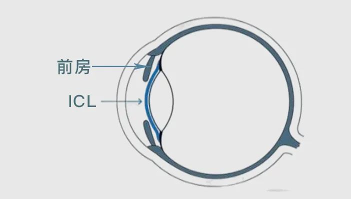 郑州ICL近视手术中的前房深度是什么?看视光眼科周远沛的解答! 哔哩哔哩