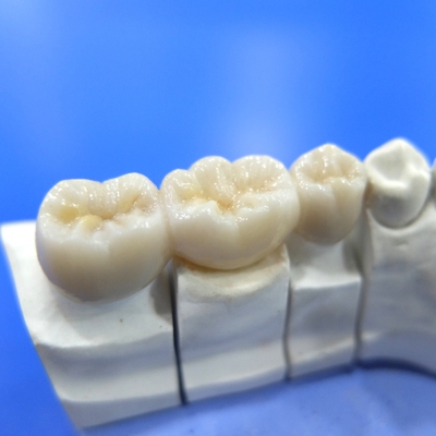 泉州全瓷牙美容冠的应用范围