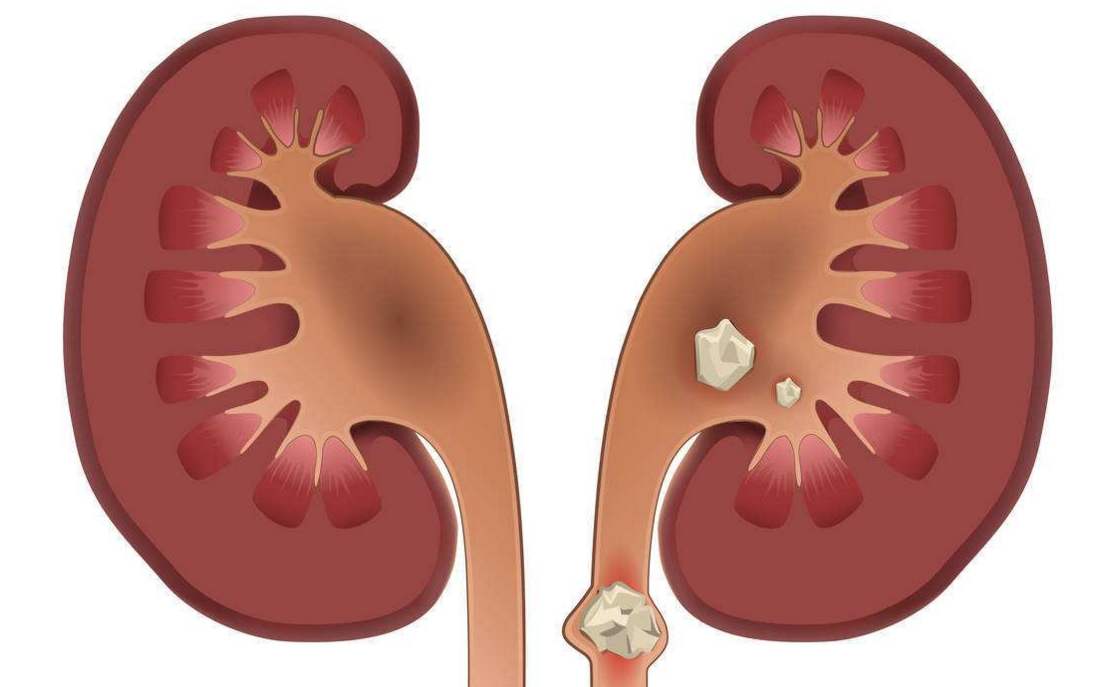腰痠痛教你不拍片子自己判斷是不是腎結石不要盲目吃藥