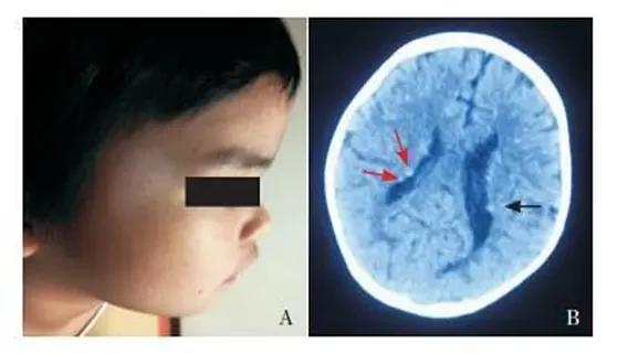 结节性硬化症临床表现