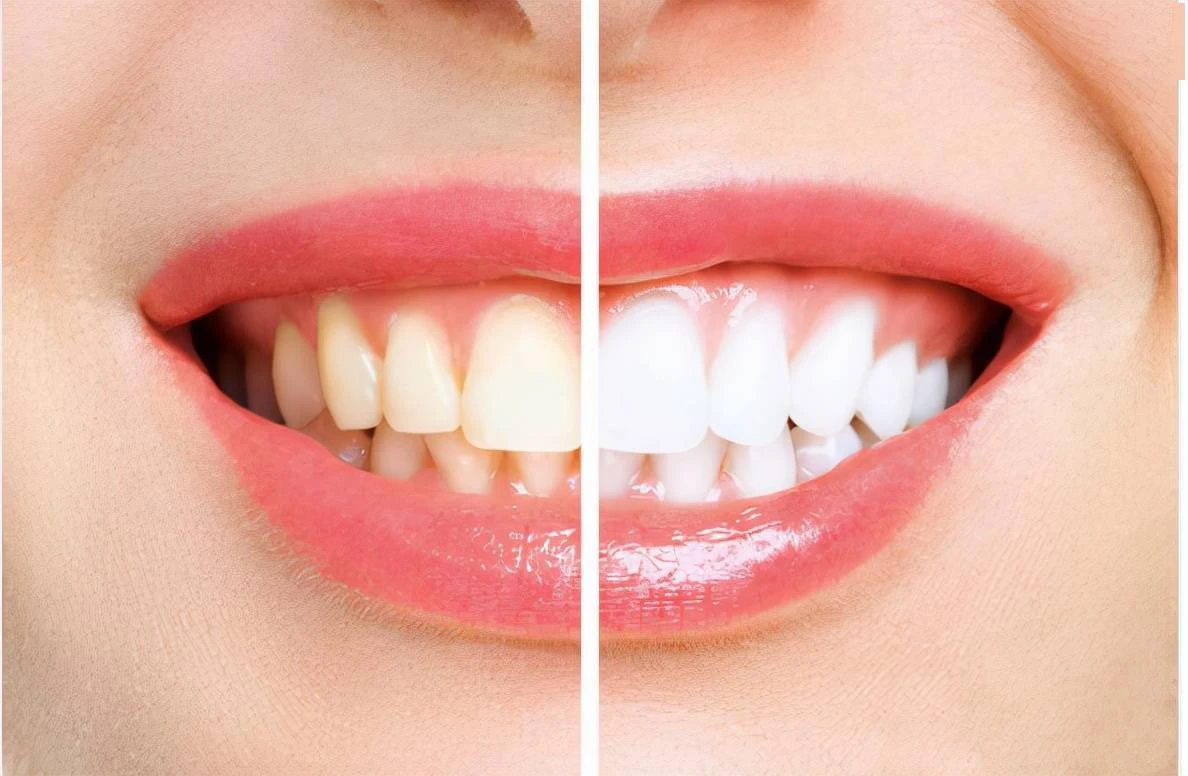 一般性黄牙做过冷光牙齿美白的对比图-赵振的博客-KQ88口腔博客
