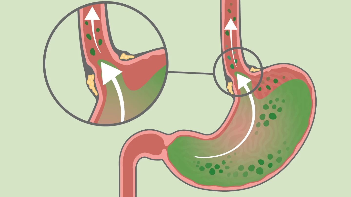 胃病，普通胃镜，慢性胃炎伴胆汁反流+幽门螺杆菌 - 知乎
