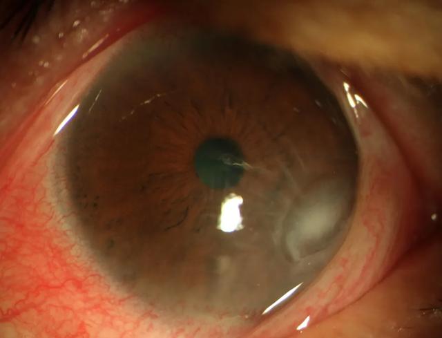 干眼引起角膜溃疡险让六旬老人失明,你还不重视干眼症吗?