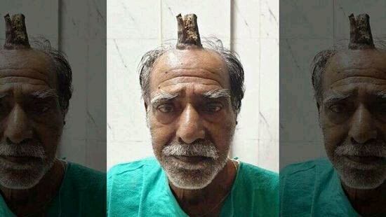 奇闻异事之印度男子头部受伤后长出"牛角"